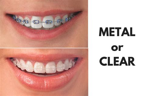 metal bracket orthodontic prices|pictures of traditional steel braces.